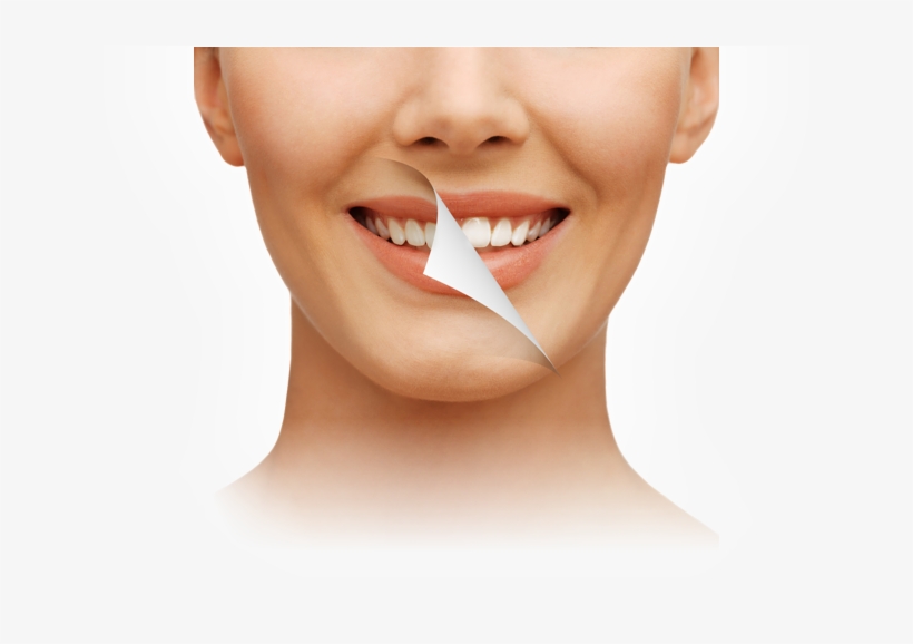 Home Bleaching, transparent png download