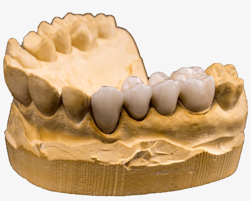 Check Out What Others Are Saying About Our Dental Crown - Ceramic, transparent png download