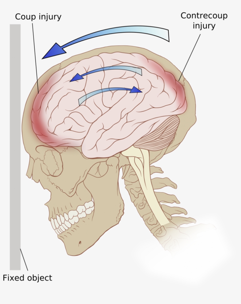 Prevalence - Traumatic Brain Injury, transparent png download