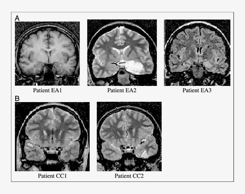 Selected Mr Images Of Patients In The Early Amygdala, transparent png download