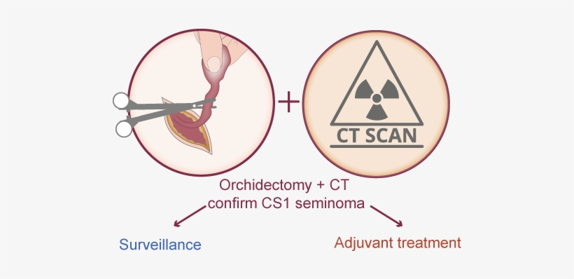 Management Of Clinical Stage 1 Seminoma With Surveillance - Circle, transparent png download