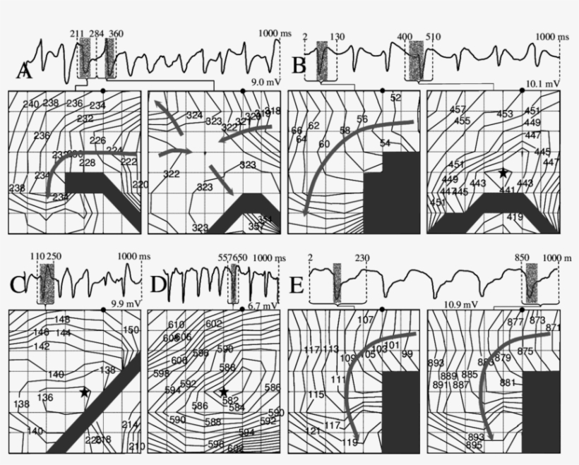 Ventricular Ectopic Beats In Aged Heart, transparent png download
