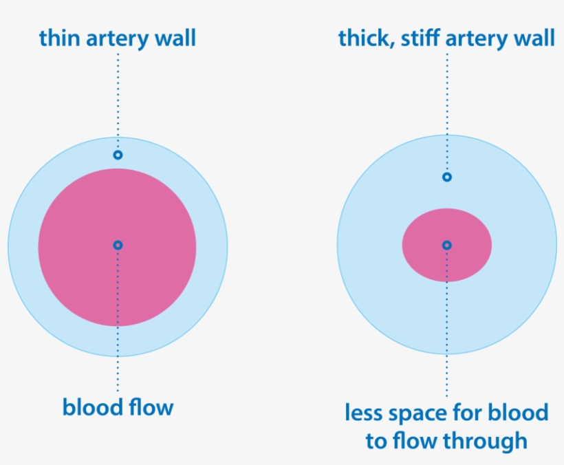 Group 1 Pulmonary Hypertension Image Showing Thick, transparent png download