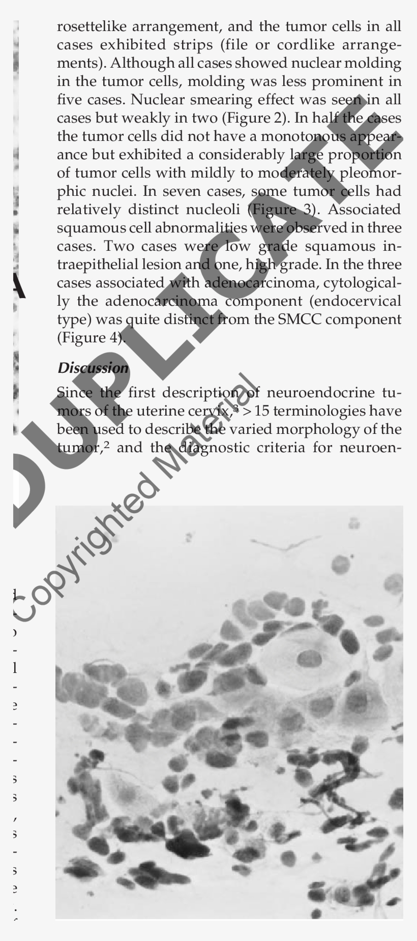 Cervical Smear Of Smcc Of The Cervix, transparent png download