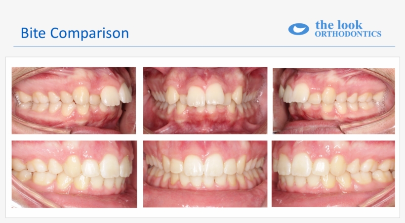 Svg Black And White Download Patient M R Crooked Protruding, transparent png download