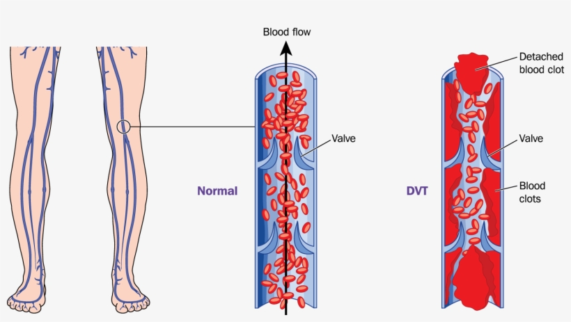 What Is Deep Vein Thrombosis - Dvt Pulmonary Embolism, transparent png download