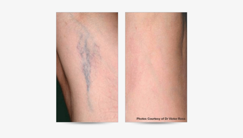 Ocean State Laser & Aesthetics, Spider Viens, Spider - Capillaries Showing Through Skin, transparent png download