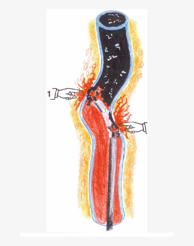 18 In Tortuous Veins, The Rigid Bare Fiber Hits The - Vein, transparent png download