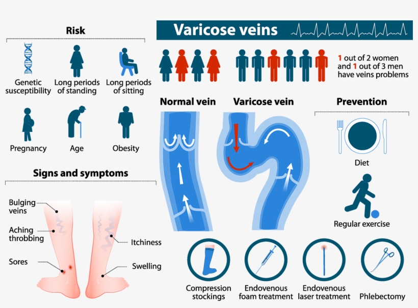 Varicose Veins Infographic Web - Risk Factor Of Varicose Vein, transparent png download