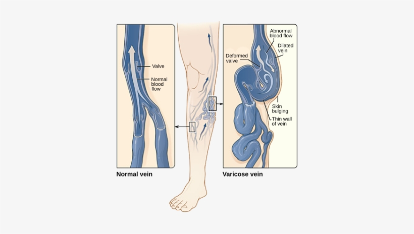 382px Varicose Veins En - Varicose Veins, transparent png download