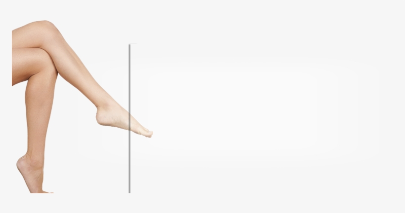 Home / Health / Phlebitis Or Varicose Veins What's - Varicose Veins, transparent png download