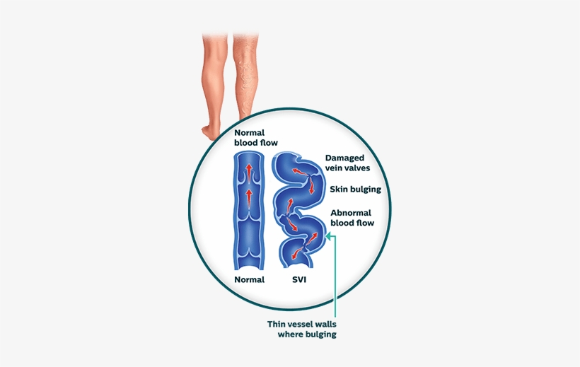 Superficial Venous Insufficiency - Graphics, transparent png download