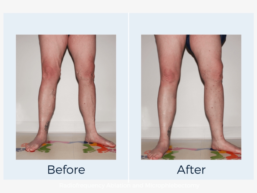 Varicose Vein Treatment And Spider Vein Treatments - Varicose Veins Ablation Radiofrequency, transparent png download