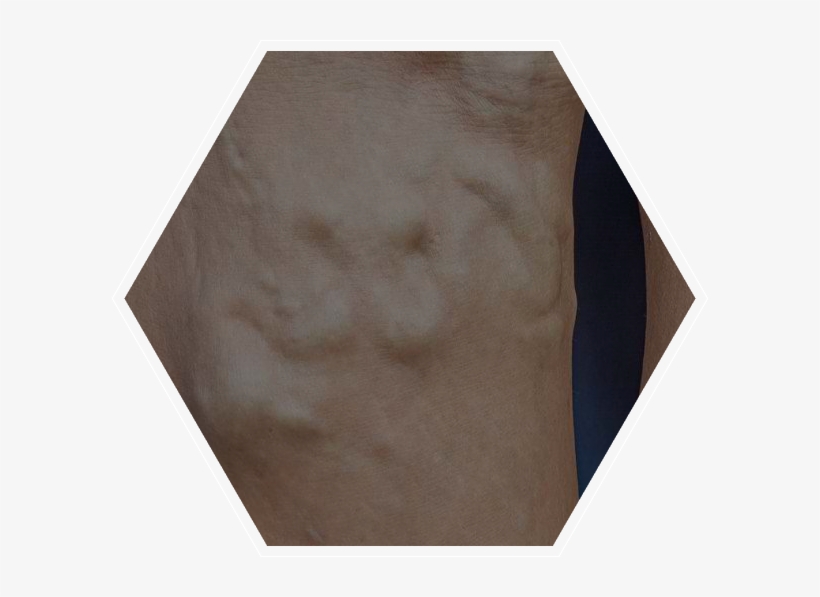 Varicose Veins, transparent png download