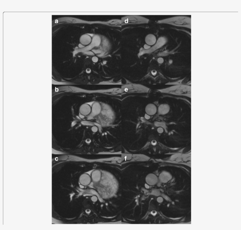 Cine Movie Mri Images In Transverse Planes In The Diastolic, transparent png download