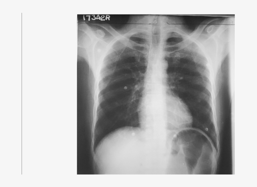 Cxr Pa Showing Distended Stomach - Stomach Cxr, transparent png download