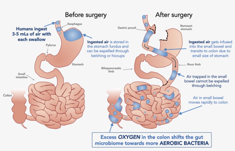 Air Hypothesis - Bariatric Surgery And Gut Microbiome, transparent png download