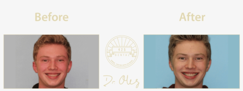 425 Before After Cosmetic46 1, transparent png download
