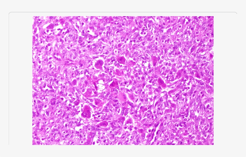 Sheets Of Mononucleated Histiocytic Cells Admixed With, transparent png download