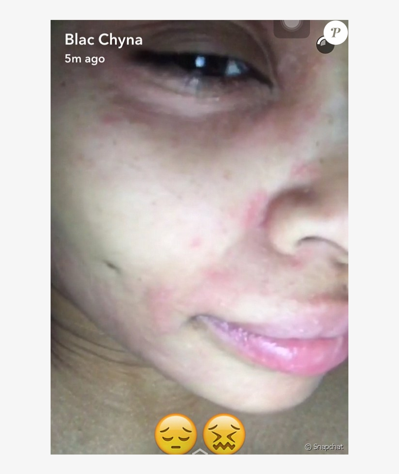 Blac Chyna A Fait Une Réaction Allergique À Un Soin, transparent png download