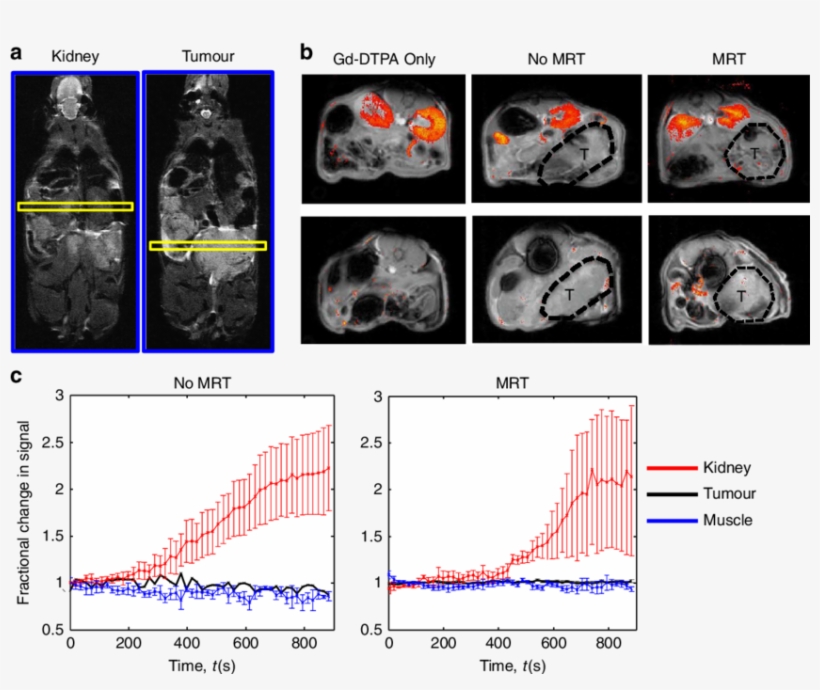 Mrt Of Magnetic Cells Into Tumours Does Not Affect, transparent png download