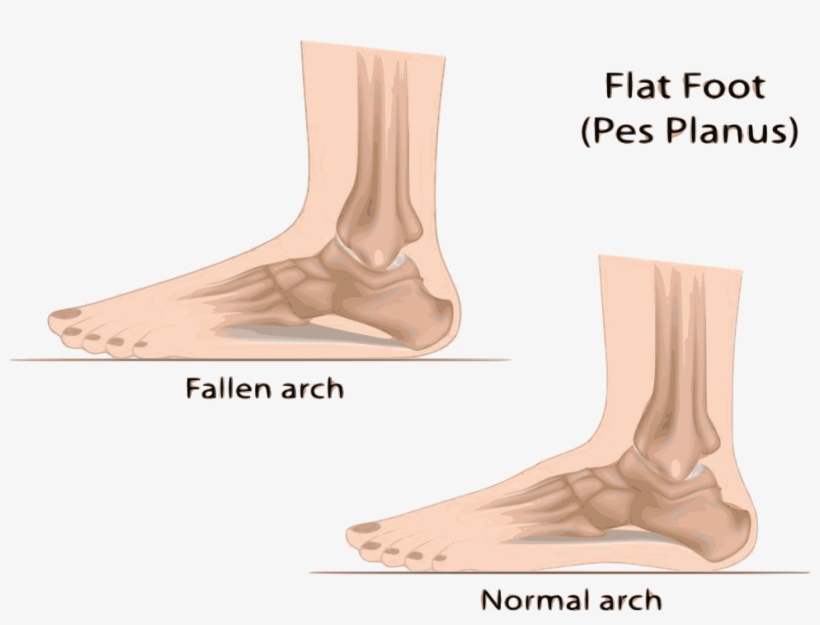 Flat Feet, transparent png download