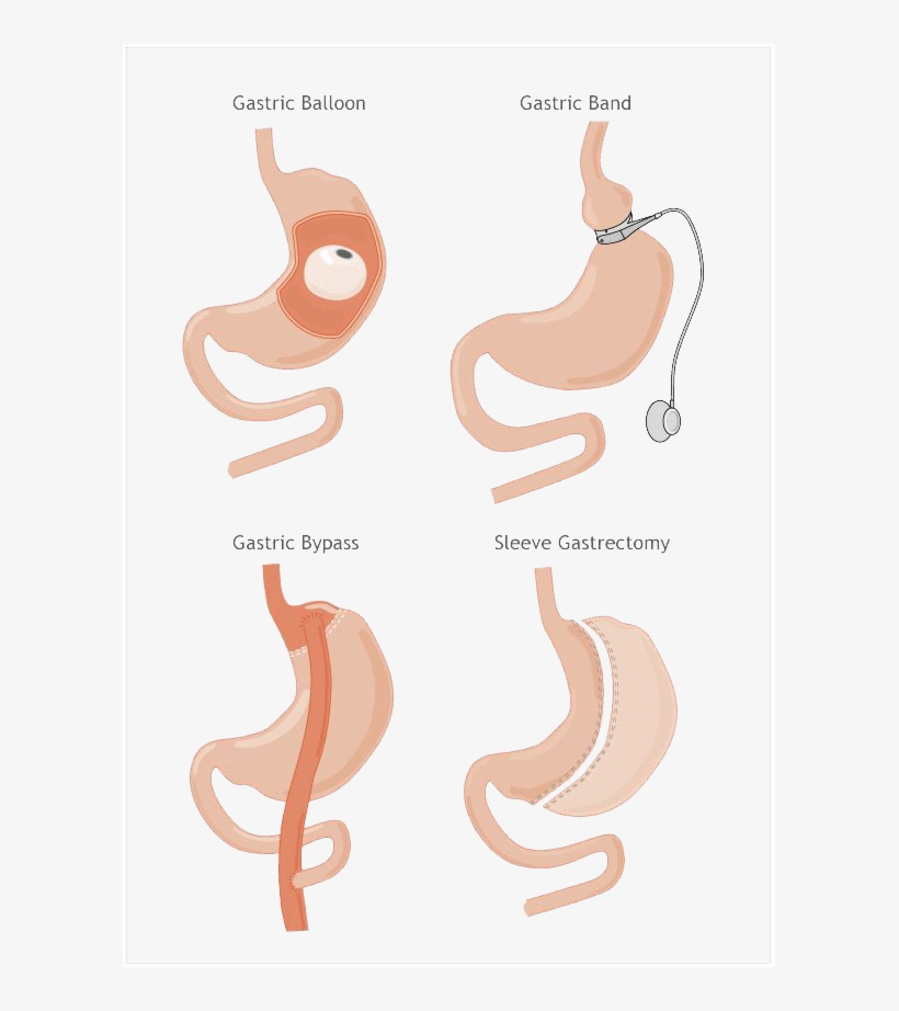 Revision Bariatric Weight Loss Surgery - Octopus, transparent png download