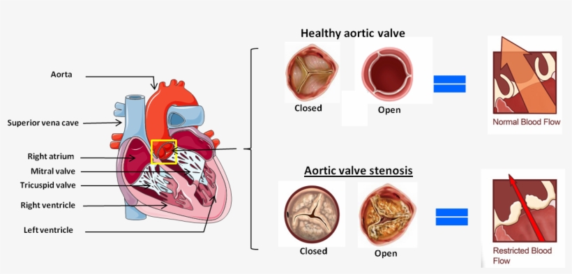 This Narrowing Can Become Severe Enough To Reduce Blood - Pannus Aortic Valve, transparent png download