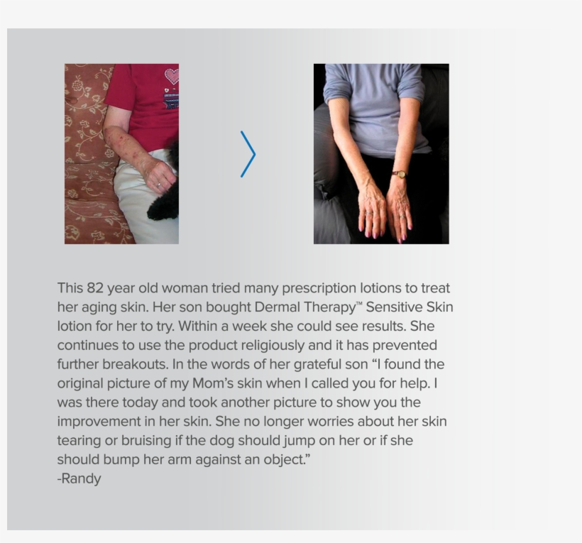 Dermal Therapy Sensitive Skin Care Soothes And Smooths - Brochure, transparent png download