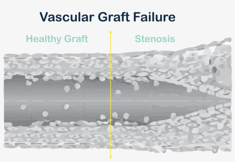Graft Failure Diagram V2-01 - Architecture, transparent png download