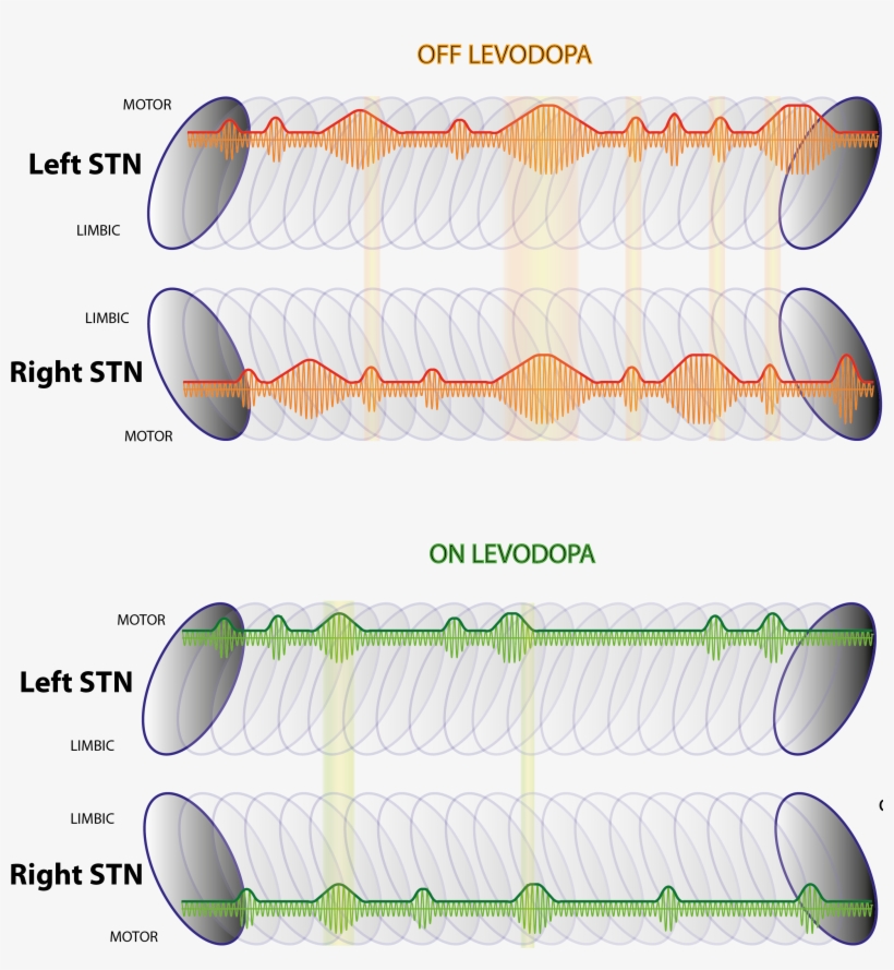 Beta Burst Dynamics In Parkinson's Disease Off And - Oval, transparent png download