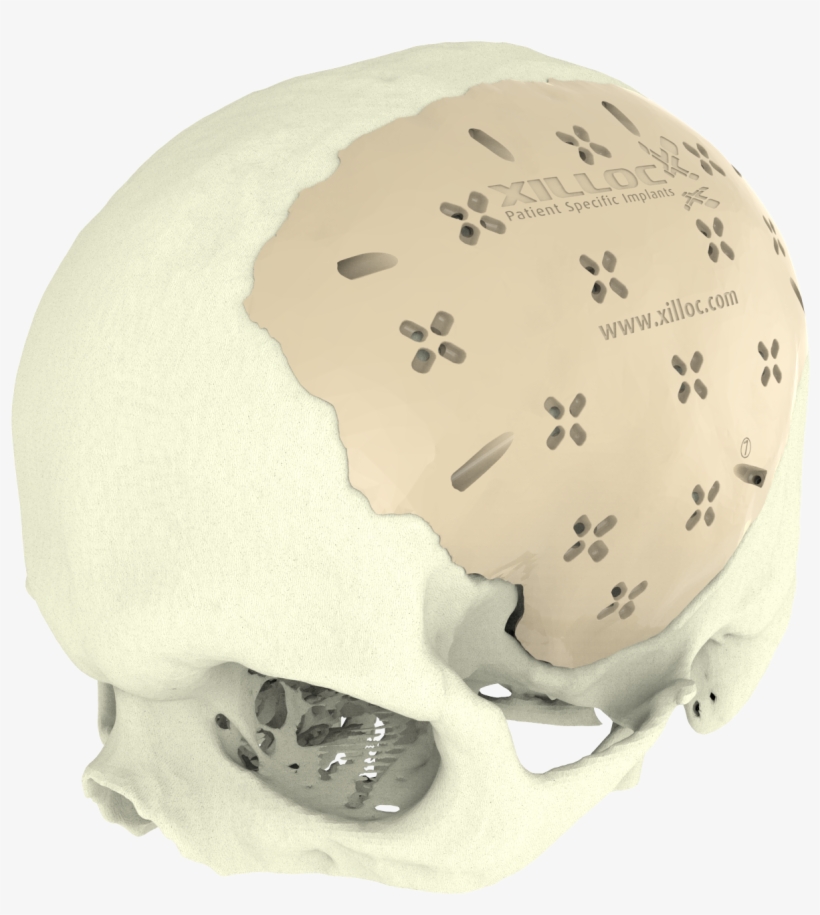 Cranial-implant - Implant, transparent png download