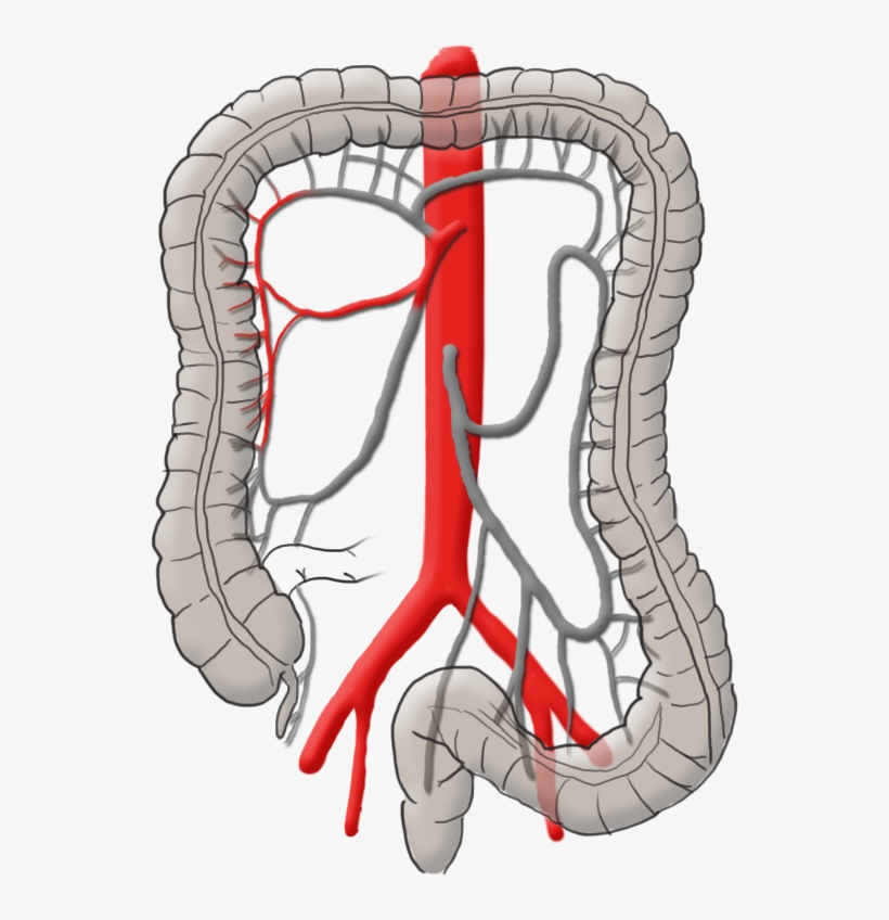 Mysurgery Carcinoma Right Colic - Operation Darmkrebs, transparent png download