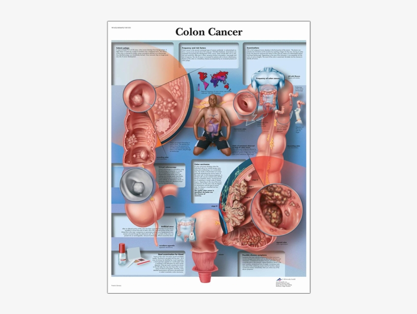 Anatomical Chart - Colon Cancer - Colon Cancer Anatomy, transparent png download