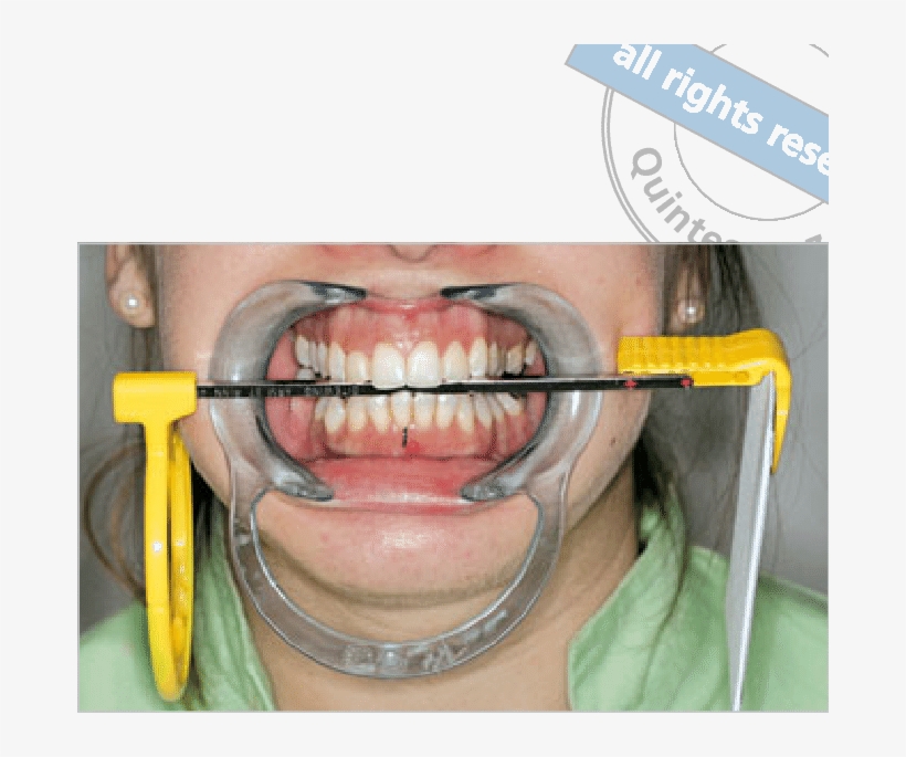 Fig 2 Radiographic Paralleling Technique With Lip Expander - Tongue, transparent png download