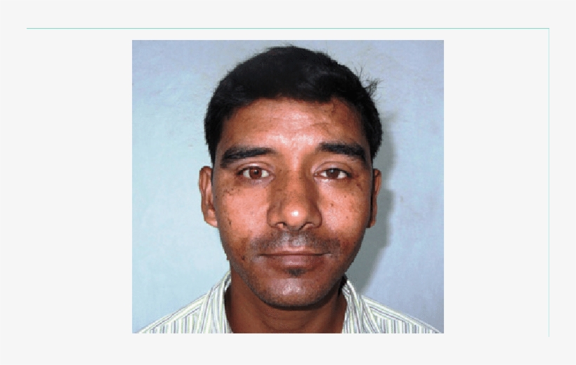 Insertion Of Ocular Prosthesis - Human, transparent png download