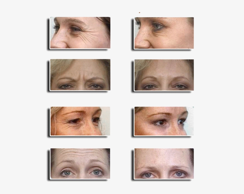 Botox Before And After - Botox, transparent png download