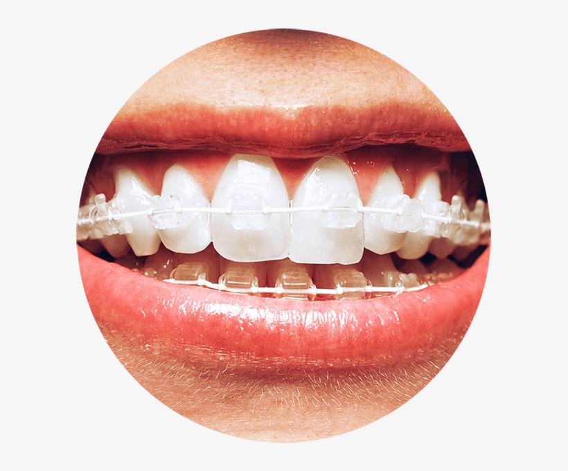 How Do Braces Work - 6 Month Smile Braces, transparent png download