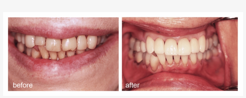 Shot Of Before And After Visiting Abington Smile Gallery - Aggression, transparent png download