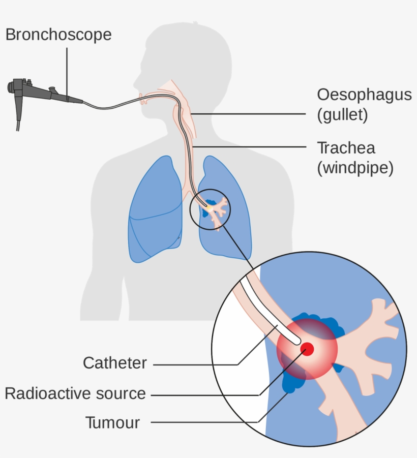 Lung Cancer Is The Leading Cause Of Death Due To Cancer - Lung Cancer Radiation Therapy Diagram, transparent png download