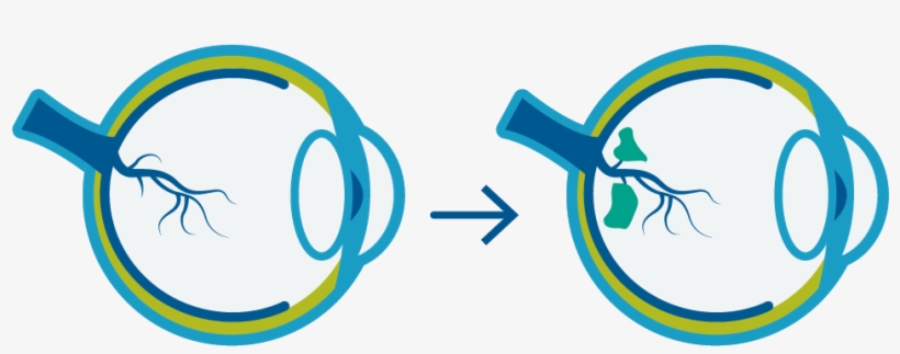 Over Time, Diabetes Can Damage Blood Vessels Causing - Circle, transparent png download