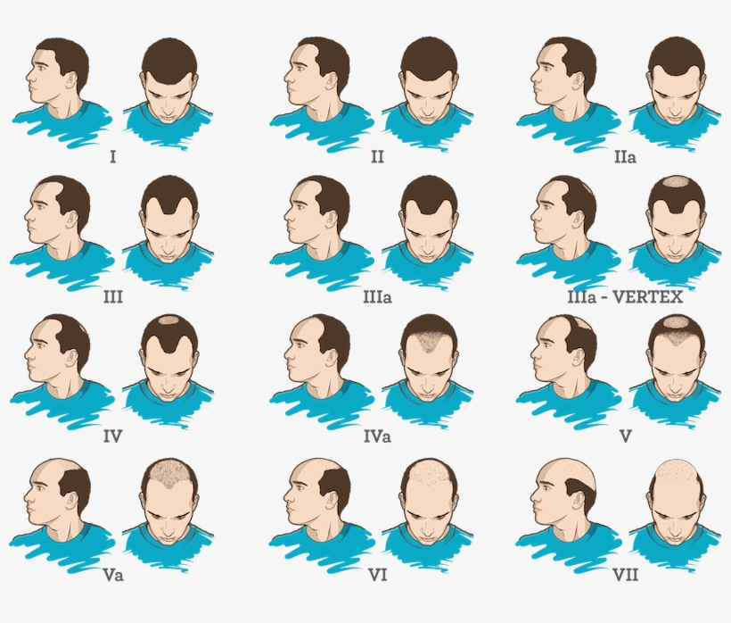 Male Pattern Baldness - Team, transparent png download