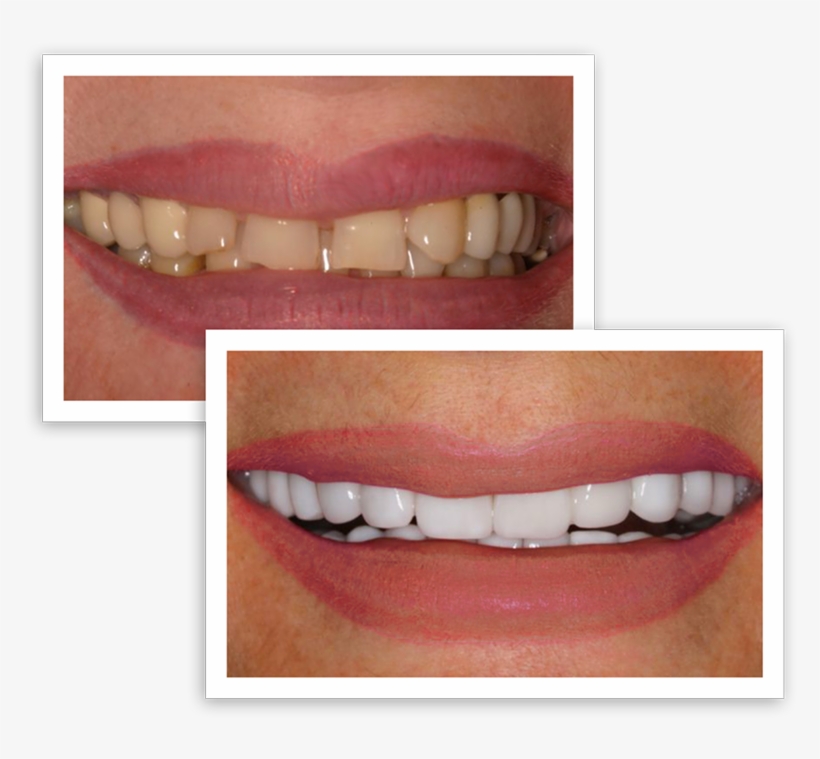 Smile Before And After Treatment - Lip Gloss, transparent png download