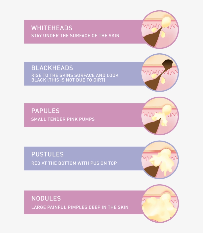 Types Of Acne Infographic - Beige, transparent png download