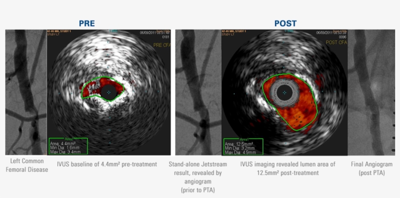 Outstanding Luminal Gain In Calcified, Eccentric Common - Atherectomy Ultrasound, transparent png download