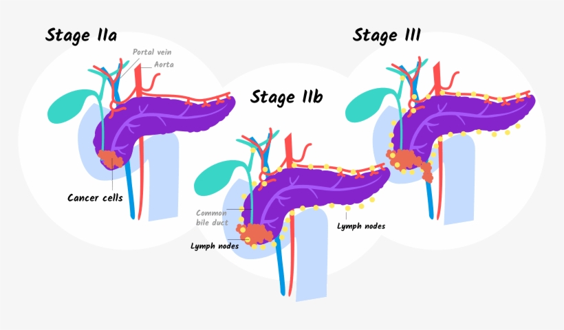 Illustration Of Stage Iia, Iib, And Stage Iii Pancreatic - 4 Pancreatic Cancer Stages That Help You, transparent png download