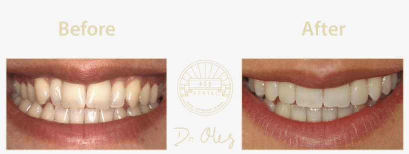 425 Before After Invisaline3 - Portable Network Graphics, transparent png download