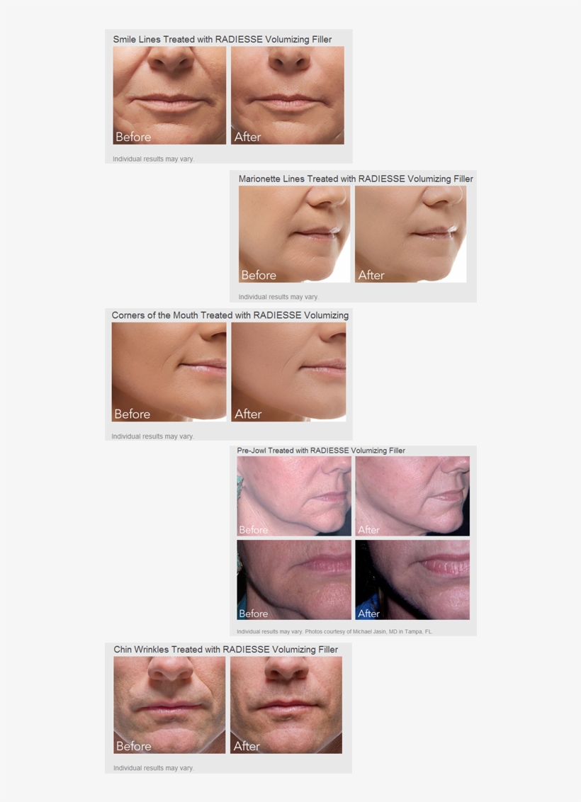 Radiesse® Wrinkle Filler Does More Than Just “fill-in” - Radiesse Before And After, transparent png download