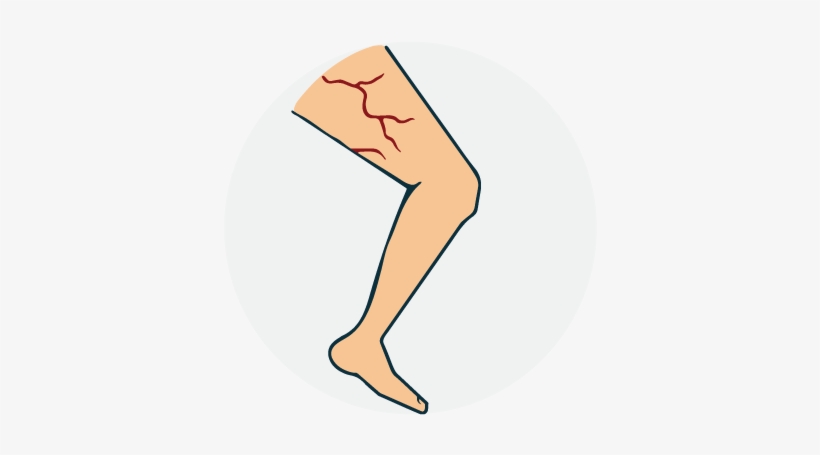Varicose Vein - Illustration, transparent png download