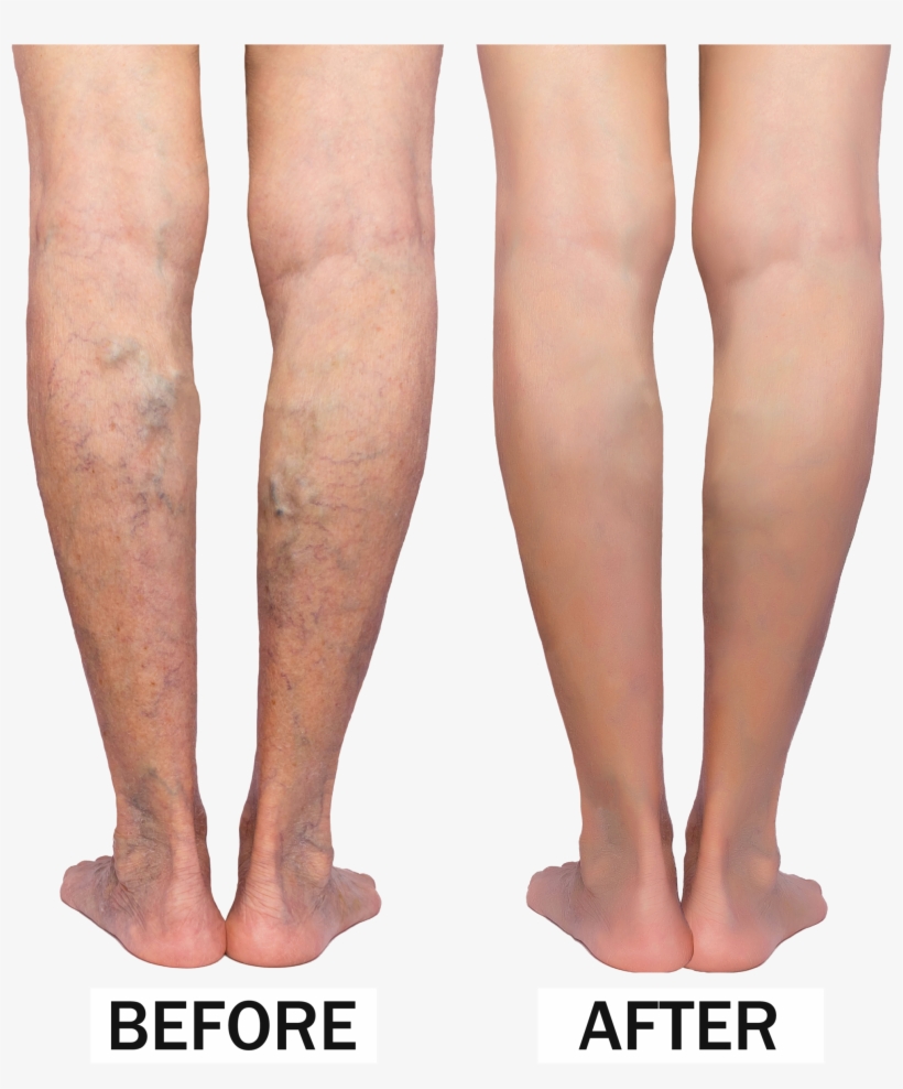 Varicose Veins Before & After - Sclerotherapy Before And After, transparent png download